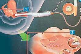 2026年未婚单身前往岳阳做试管要准备多少钱？十五万够吗？